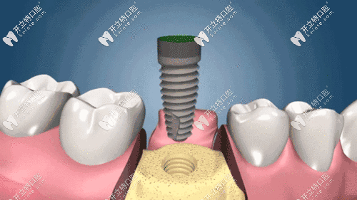 韩国登特斯dentis种植牙