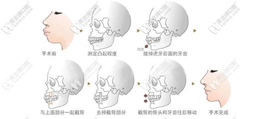 正畸正颌联合治疗凸嘴