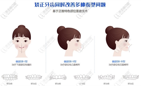 正雅矫正技术在矫治牙齿的同时还能改善面型问题