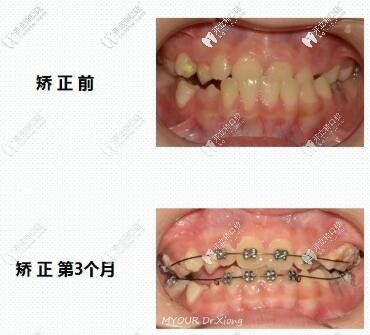 长沙美奥口腔熊安凤反颌矫正案例案例