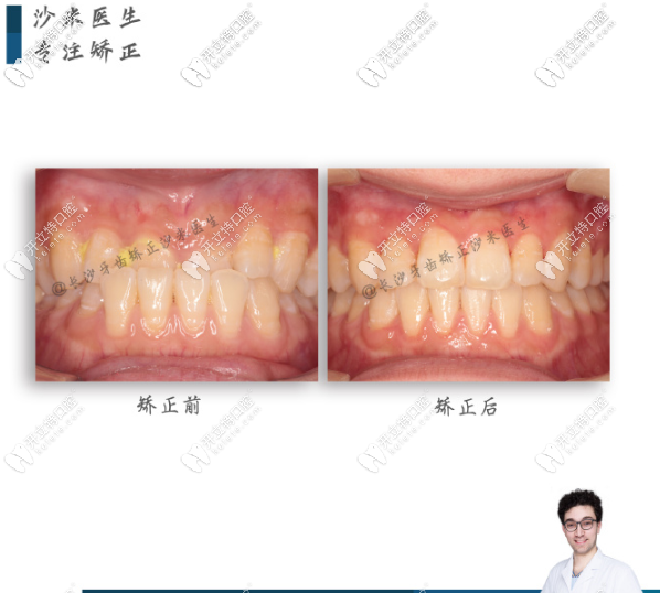 牙祖口腔沙米矫正案例