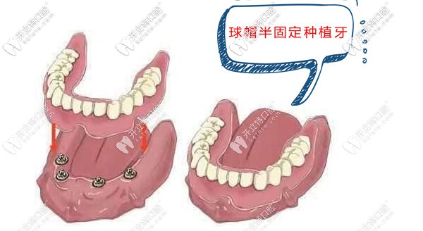 廊坊爱嘉口腔半口球帽半固定种植牙