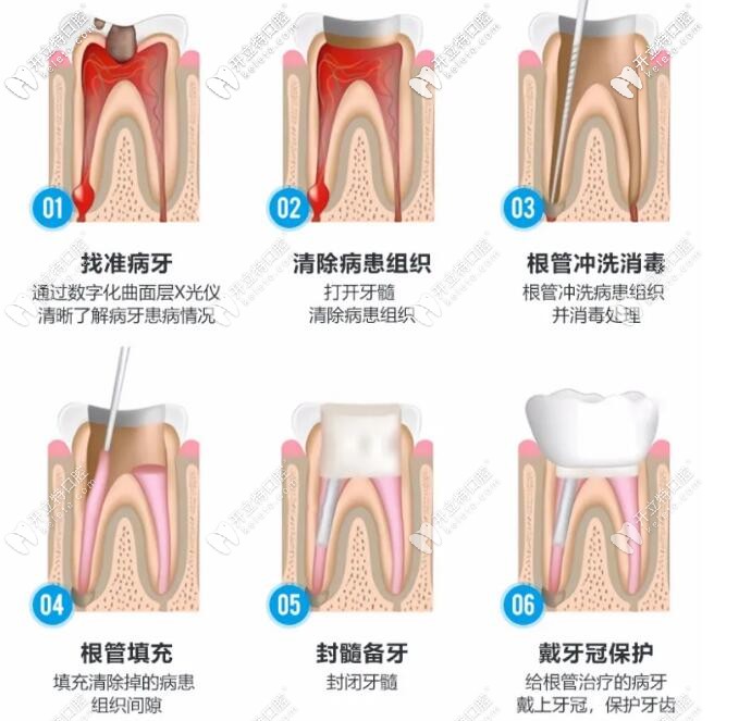 显微镜根管治疗术过程的步骤