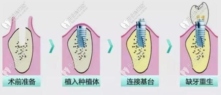 种植牙过程