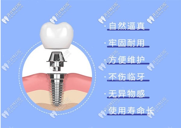 国产种植体cdic真的不错