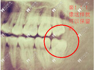 比较正的智齿不用拔除