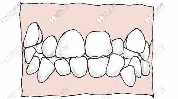 牙齿重度拥挤不齐示意图