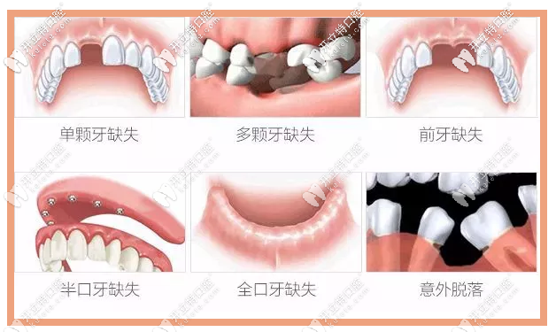 瑞典诺贝尔种植系统适应症