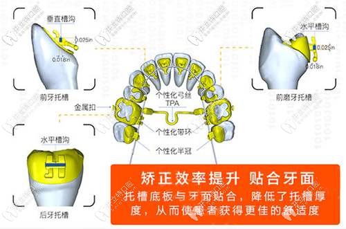 舌侧矫正的特点