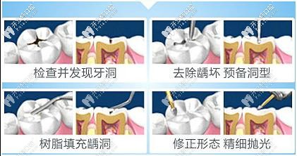 补牙过程