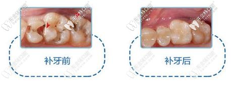 补牙前后对比