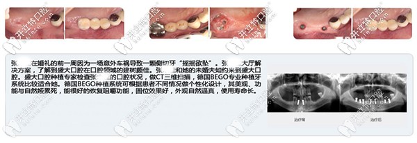 沈阳盛大口腔多颗牙缺失