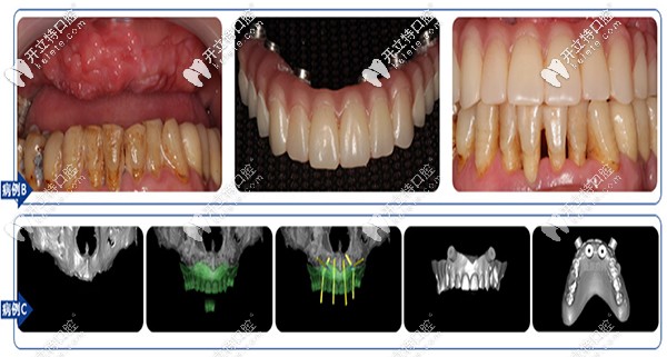 沈阳盛大口腔全口、半口缺失案例