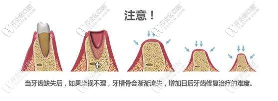 牙槽骨会日渐萎缩