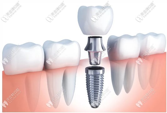 种植牙结构