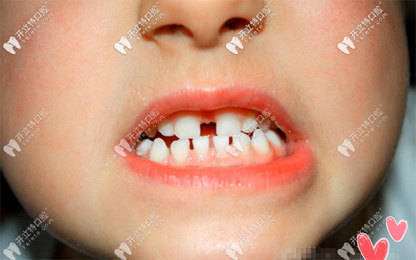 换牙期门牙缝隙大图片图片