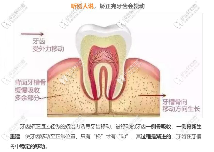 矫正完牙齿会松动吗