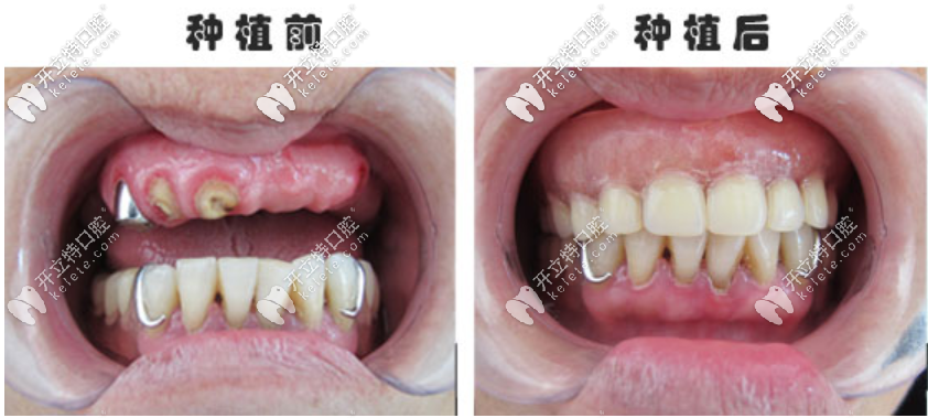 种牙前后对比