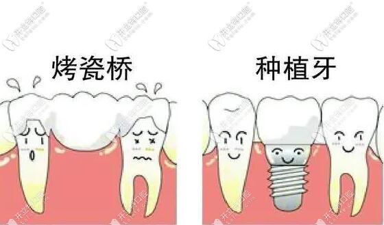 缺牙必看种牙3年就坏了是真的吗是不是种植牙都会骨吸收