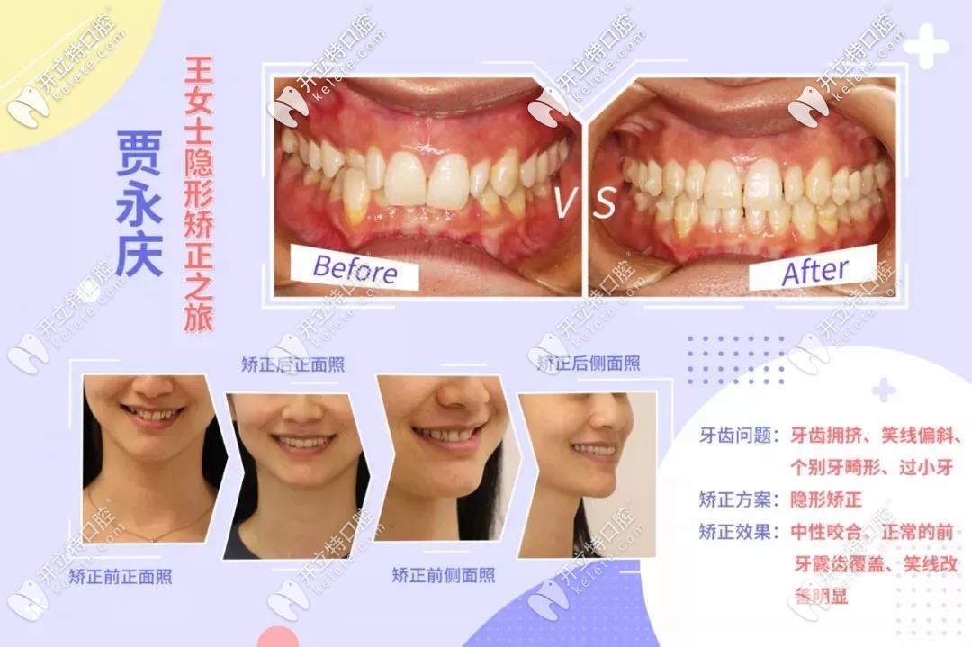 牙齿拥挤、笑线偏斜的矫正前后对比