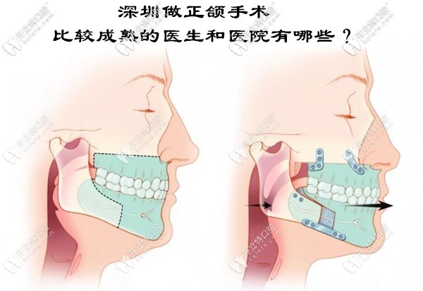 深圳正颌手术比较成熟的医生和医院有哪些