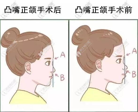 凸嘴正颌手术前后对比图