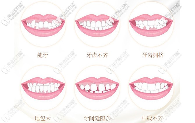 牙齿矫正的适应症状