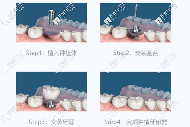 种植牙的简单流程