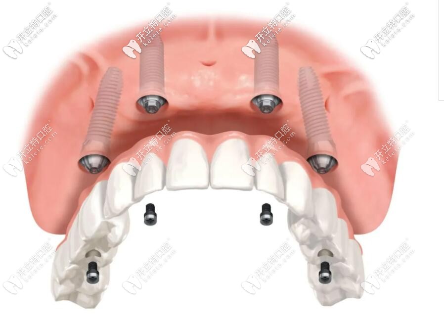 allon4种植半口牙的示意图