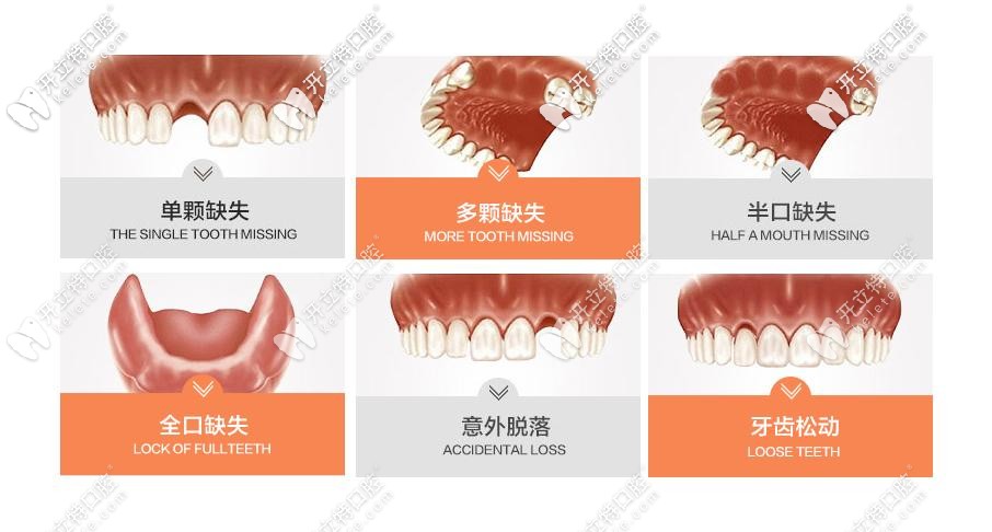 种植牙适应症