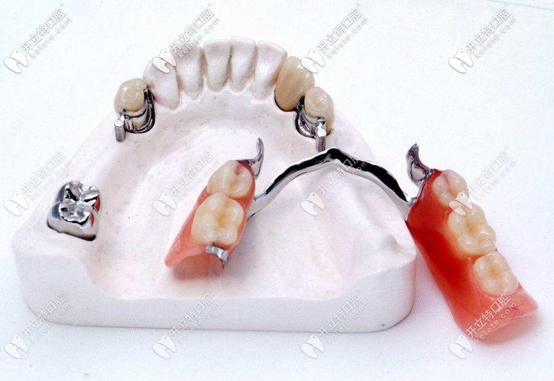 牙齿精密附件图片