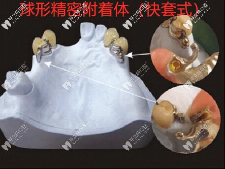 球形精密附着体（快套式）