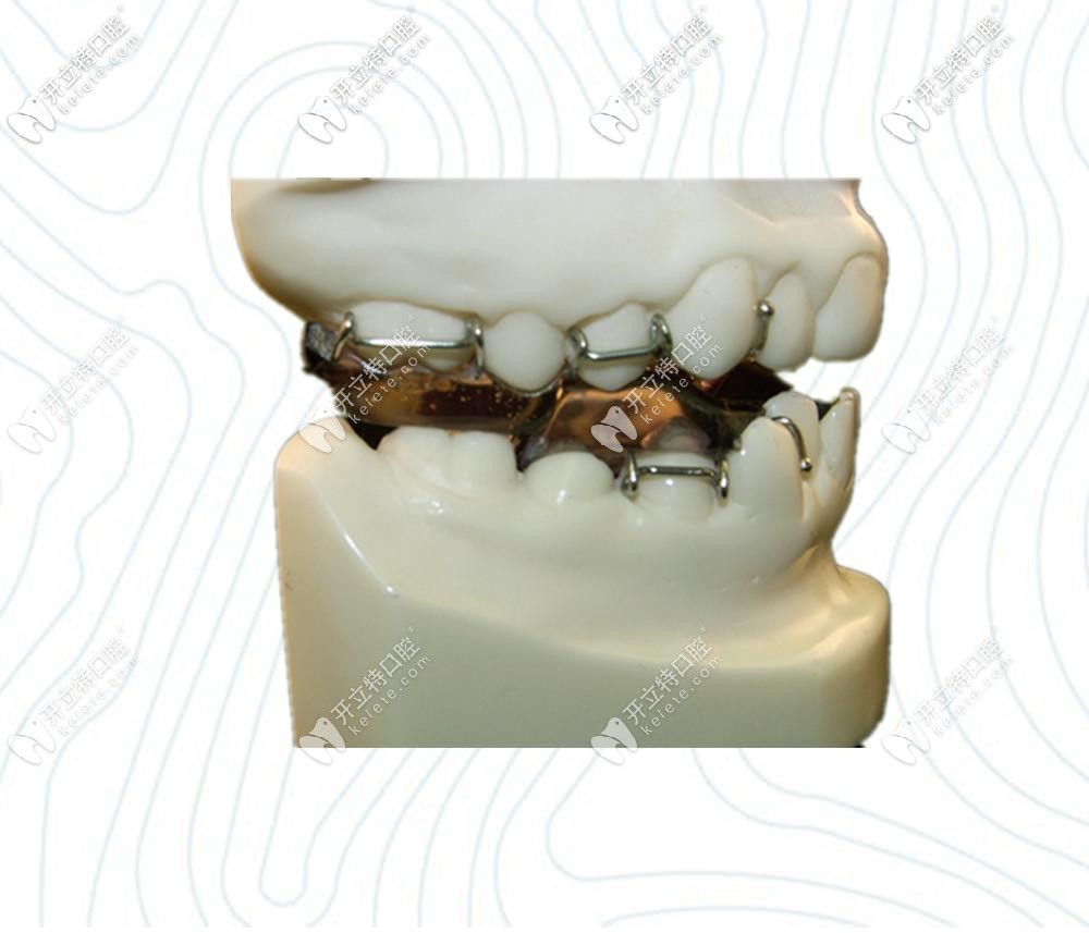双颌垫矫治器twinblock