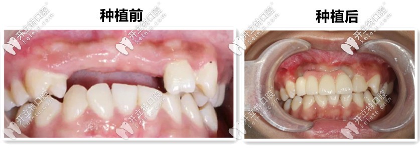 19岁妞门牙缺失4个来吐槽郑州唯美口腔的种植牙技术