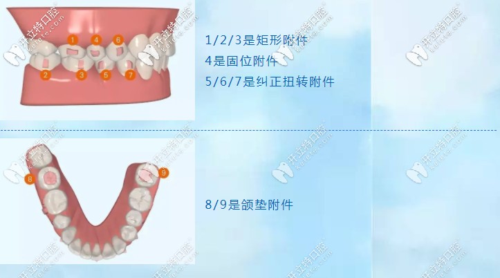 正畸附件