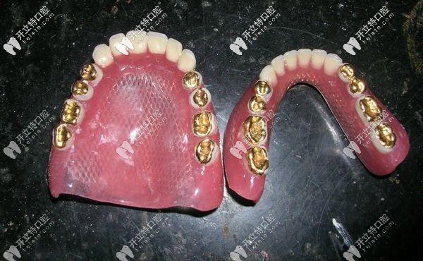 满口牙周病想镶牙,请问活动假牙中的钛合金和纯钛区别大吗