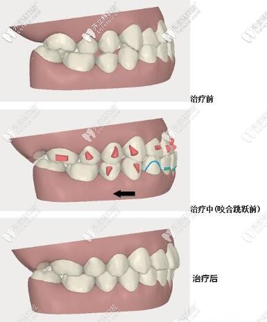 磨牙后推前后对比