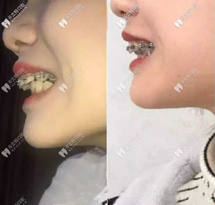 矫正前后对比效果图▼上面这位小仙女天包地牙齿矫正后脸型变化大不大