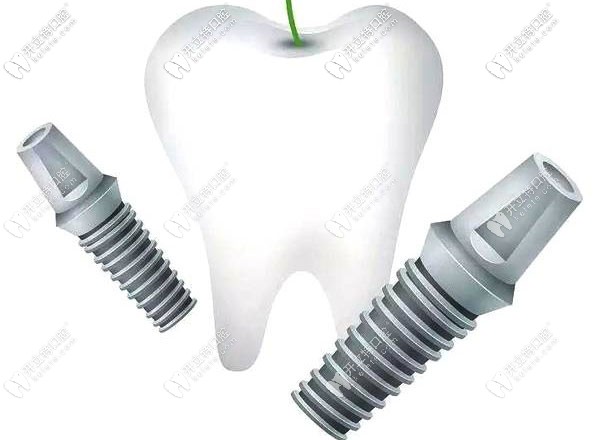 三颗牙掉了需种植几颗牙根?可否用2颗种植体装三个牙冠呢