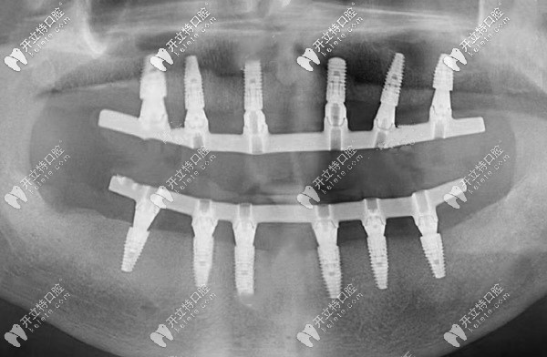all-on-six即刻种植牙的全景片
