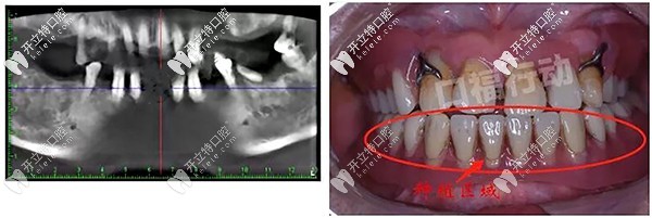 昆明美奥口腔昆明美奥口腔allon4半口种植牙案例分享:牙周病残根也能修复