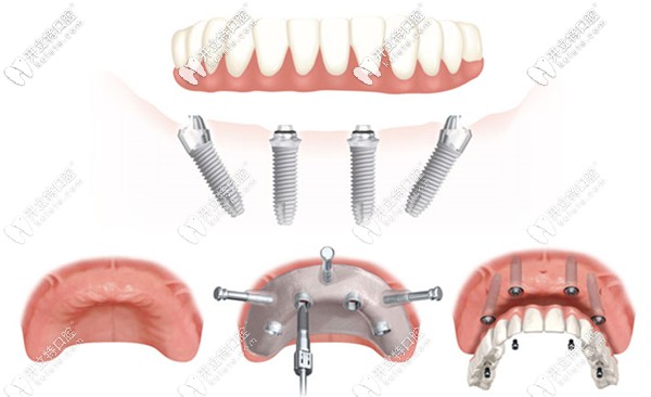 all-on-4种植牙技术示意图