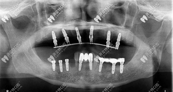 半口牙种植6或8颗植体全景图