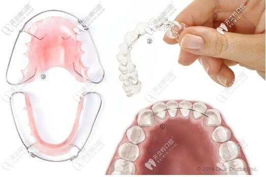 正畸治疗后为啥要佩戴保持器
