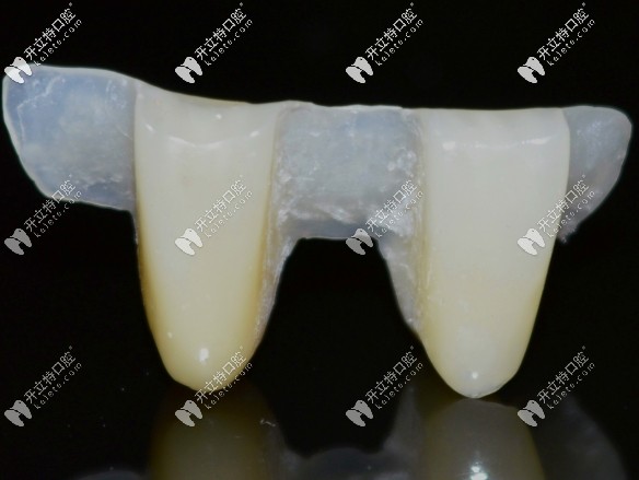 马里兰桥修复义齿适应哪些牙,为啥网传马里兰桥被淘汰了？