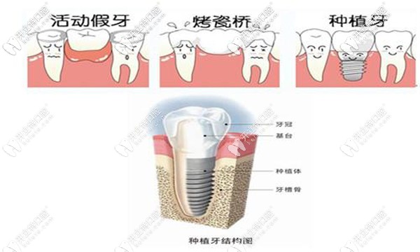 种植牙与活动假牙、烤瓷牙对比图