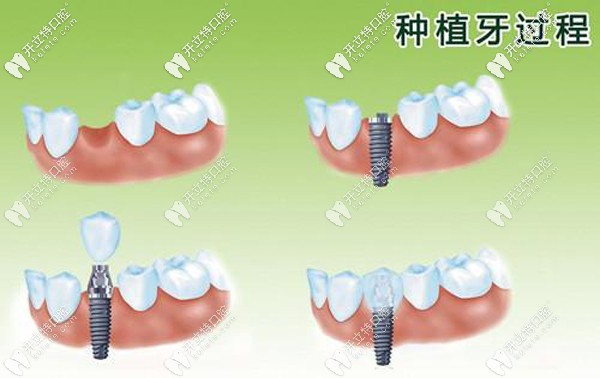 种植牙过程图
