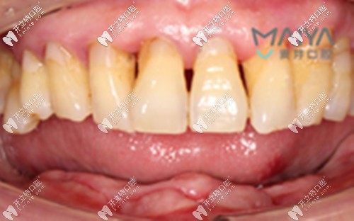 下半口桥架式种植牙案例:只需5颗种植体就能恢复半口牙