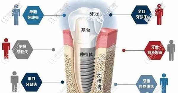 种植牙适应症状如图所示