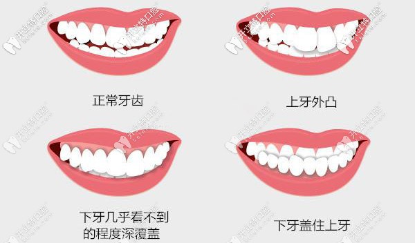 牙齿外凸、深覆合等情况都需要矫正